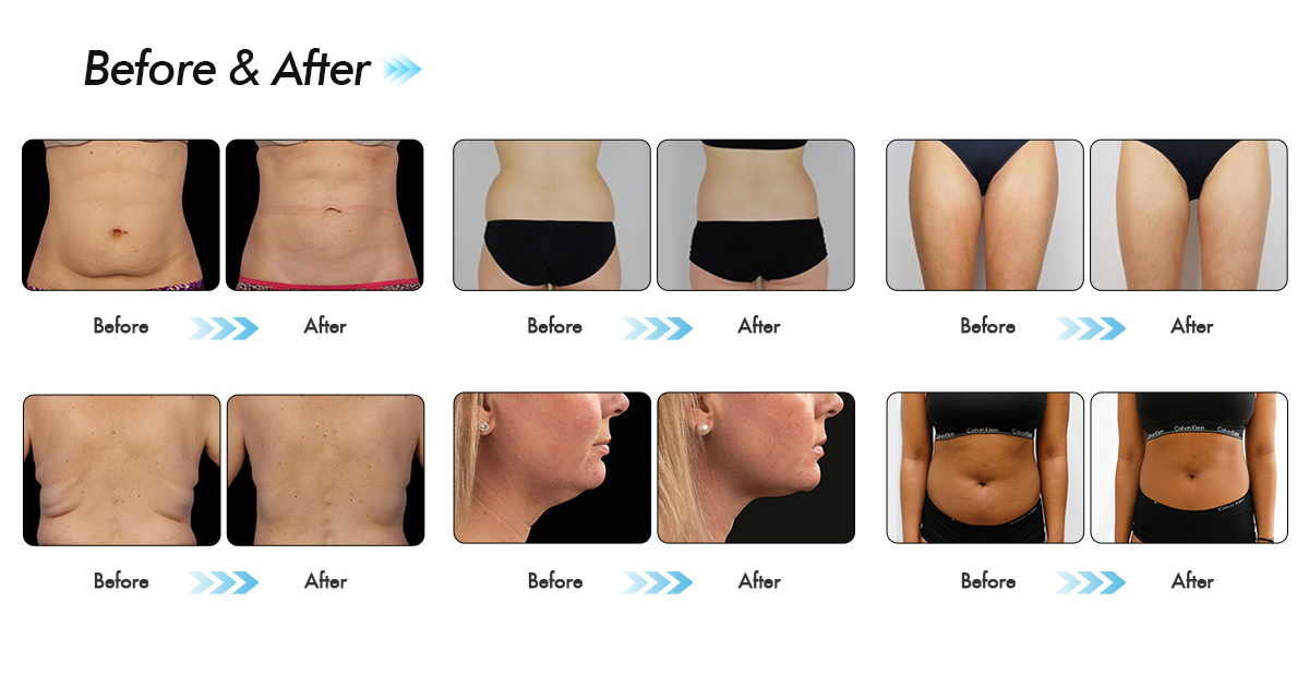 Cryolipolysis Slimming Machine