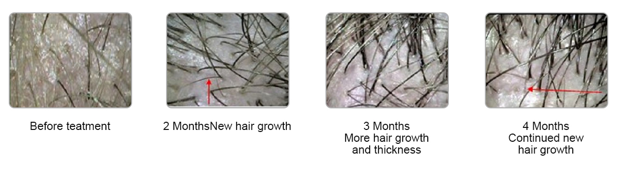 650nm 808nm Diode Laser Hair Regrowth Machine