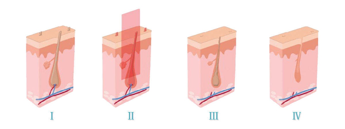 ipl beauty equipment