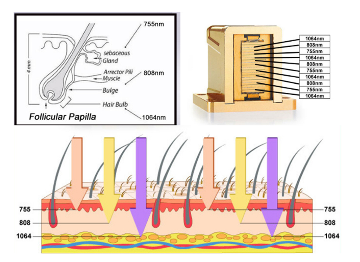 05Vertical Triple Wavelength Diode Laser Hair Removal System