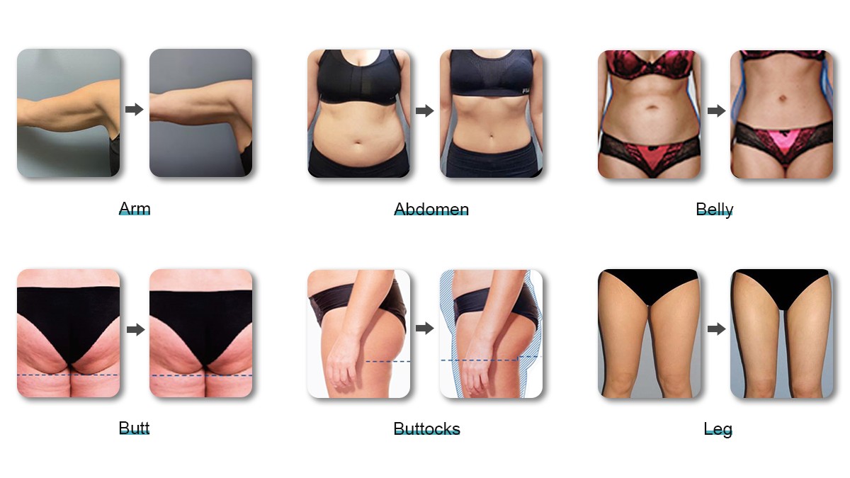 ems sculpting machine