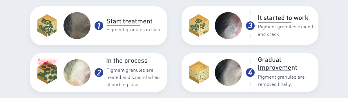 q switched Nd Yag Laser machine
